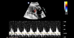 Ecocardiograma fetal qué es y cuándo es necesario