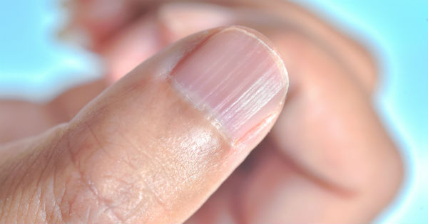 Aprender acerca 36+ imagen uñas dañadas con rayas